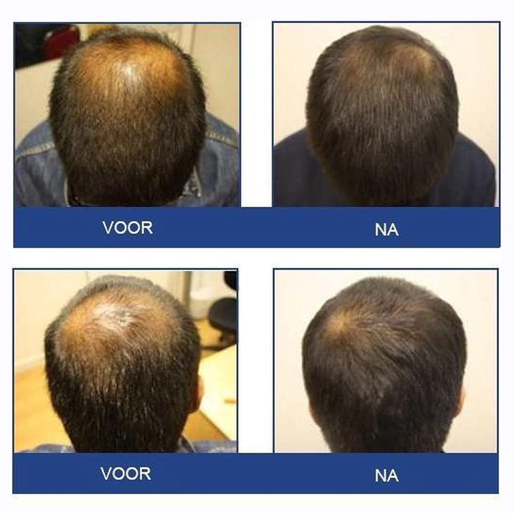 FOLIGAIN Lotion against Hair Loss for Men (59 ml.) before and after